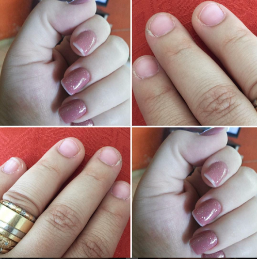 Colagem mostra fotos de unhas de pacientes de câncer de mama